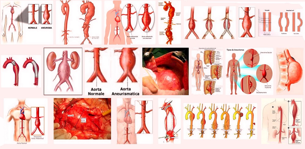 tabella delle aorte